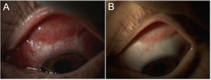 Formation of symblepharon in fundus of superior conjunctival sac. A) Oedema and severe conjunctival adhesions are seen in fundus of superior conjunctival sac. B) Superior conjunctival symblepharon (adhesions) as sequelae following resolution of signs and symptoms.