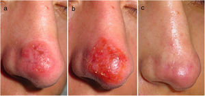 Course of cutaneous leishmaniasis: before, during and after imiquimod 3.75%. (a) Erythematous–oedematous plaque on the patient's nose prior to starting treatment. (b) Local inflammatory reaction three weeks after starting imiquimod. (c) The patient's nose with no leishmaniasis lesions four months after ending treatment.