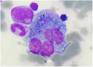 Smear of peripheral blood with histoplasma inclusions (number 1) inside the macrophage.