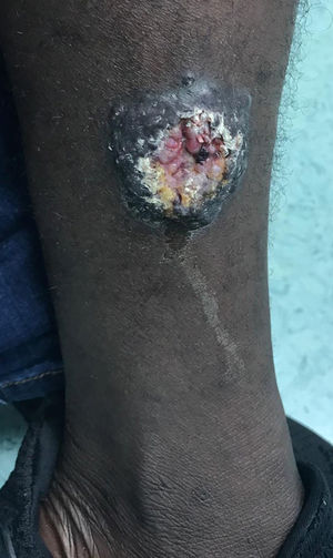 Nodular lesion measuring 35 × 40 mm ulcerated in the center, pretibial area of the left leg.