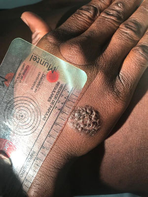 Nodular lesion 20 × 25 mm, dorsum of the right hand.