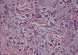 Punch of the lesion in Fig. 1. Intracellular amastigotes can be seen.
