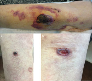 Polymorphic skin lesions. (A) Back of left forearm: a poorly defined, stony tumour plaque with a blackish crusty surface, 3.5cm×2cm in diameter, with peri-lesional ecchymotic plaques. (B) Front of the right leg with two rounded plaques 1.5cm in diameter. (C) The left knee has a plaque with a diameter of 2.5cm with irregular, raised borders and a friable, bleeding centre.