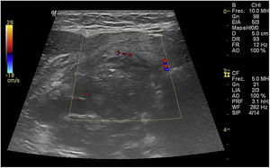 Initial neck ultrasonography (USG) showing a complex lesion in the right thyroid lobe measuring approximately 5.4cm×3.1cm×3.2cm with peripheral vascularity.