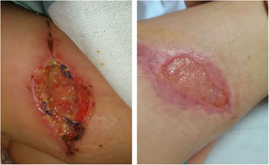 Appearance of the injury prior to debridement and after two months of treatment.