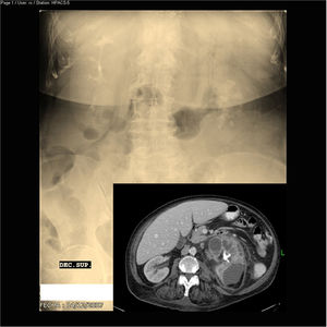 Urography: large staghorn calculus occupying practically the entire left excretory system with loss of ipsilateral kidney function and compensatory hypertrophy of the contralateral kidney. Abdominal CT scan with contrast: large calcified staghorn calculus, left nephromegaly, intrarenal collections and significant perirenal inflammatory changes.