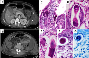 (A, B) Abdominal CT scan showing ascites in addition to small and large bowel wall thickening. (C–G) Duodenal biopsies showing S. stercoralis larvae and abundant eosinophils in the lamina propria (H & E [C–F] and PAS [G] stainings).