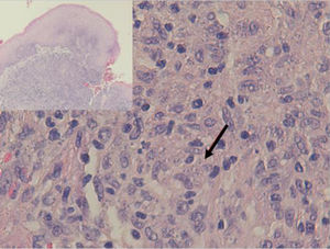 Haematoxylin-eosin (×40). Amastigotes within histiocytes.