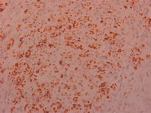 Immunohistochemical CD1a (×40). Kinetoplast reinforcement of amastigotes.