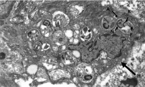 Electron microscope photograph. Histiocyte (H) whose cytoplasm contains amastigotes (A) distinguishing their nucleus (N), the kinetoplast (K) and their flagellum (F).