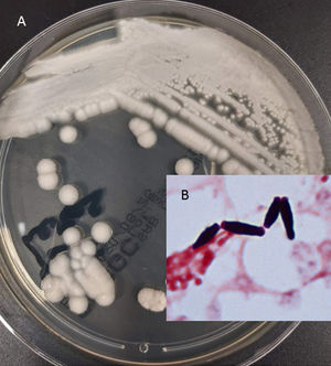 A. Macroscopic morphology of colonies of Geotrichum capitatum after 48 h of incubation on Sabouraud agar. B. Arthroconidia in Gram stain from a blood culture vial (1000×).