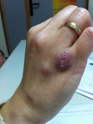 Ulcerated nodular lesion at the site of infection with a well-defined border covered with a scab. Three nodules on the back of the hand and on the right wrist.