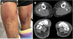 (A) An erythematous rash with ecchymosis was noted below the knees. (B) Magnetic resonance imaging showed volume increase and soft tissue edema of both legs.