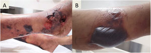 (A, B) Ecchymosis and multiple hemorrhagic bullae on legs, the largest of 8cm by 4cm.