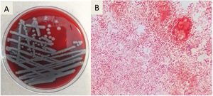 (A) Identification of V. vulnificus on Blood agar. (B) Hemorrhagic bullae and subcutaneous cellular tissue culture revealed curved Gram-negative rods (V. vulnificus).