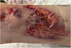 Abscessed lesion with sanguinopurulent discharge.