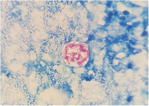 Ziehl–Neelsen staining of the lesion. Acid/alcohol-fast bacilli are seen.
