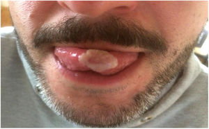 Whitish lesion on the tip of the tongue.