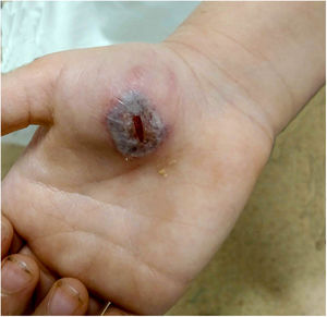 A 4-cm purplish erythematous plaque with granulation tissue in its interior, on the right thenar eminence.
