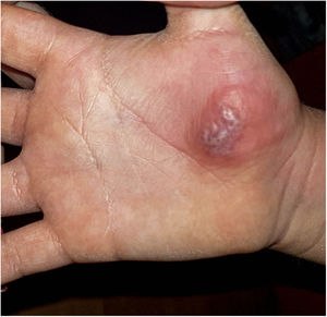 Image showing the evolution to vesiculous lesions and crusts.