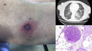 a) Photograph of the lesion located on the outer region of the right knee. b) Chest CT image with pulmonary window showing the bilateral 'cobblestone' pattern and several nodules. c) Haematoxylin-eosin ×40: medium-sized vessel completely blocked by a thrombus of fungal structures.