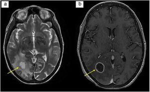 (a) T2-weighted brain MRI: rounded lesion of layered appearance in the white matter of the right occipital lobe measuring 1.7 cm in diameter. Moderate surrounding vasogenic oedema; (b) T1-weighted brain MRI with contrast: homogeneous, smooth and fine annular peripheral enhancement following administration of intravenous contrast.