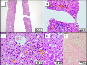 Histology of liver biopsy: grade 1 macrovesicular and microvesicular steatosis. No signs of acute graft rejection. I, II, III and IV: ductular cholestasis with cholangiolitis. V: mild haemosiderosis (Perls stain).