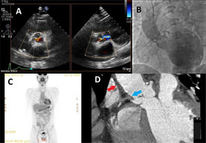 A) Severe aortic insufficiency in a transthoracic echocardiogram. B) An aortogram showing a non-dilated aorta, occlusion at the origin of the right coronary artery (RCA) and severe regurgitation. C) 18F-FDG-PET/CT with significant hyperenhancement in the ascending aorta. D) CT angiography showing thickening of the aortic wall (red arrow) and occlusion of the RCA (blue arrow). 18F-FDG PET/CT: positron emission tomography/computed tomography with 18F-fluorodeoxyglucose; CT angiography: computed tomography angiography.