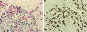 A) Lymphoplasmacytic infiltrate in adventitia and middle layer. B) Negative immunohistochemistry for Treponema pallidum.