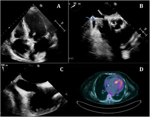 A) Transthoracic echocardiogram in which a thickened Eustachian valve can be observed. B) Transoesophageal echocardiogram showing a mobile mass adhered to the valve (arrow). C) After antibiotic treatment, the mass has almost completely disappeared. D) PET/CT, slight pericardial uptake suggestive of an inflammatory process.