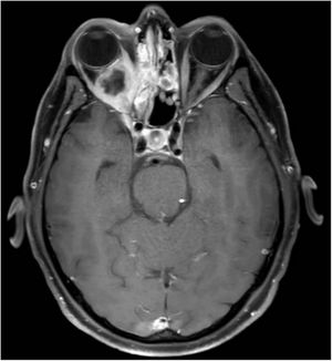 T1-weighted transverse slice showing significant inflammatory component of the right sinus and orbital structures with slight protrusion of the eyeball.