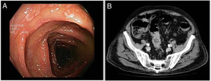 A) Areas of erythematous mucosa covered in whitish formations seen in the colonoscopy prior to admission. B) Concentric wall thickening 5 cm long in the sigmoid colon with signs of mild involvement of perisigmoid fat.