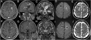 Top rows show initial magnetic resonance imaging (MRI) and bottom rows show follow-up MRI. Axial (A) and coronal (B) contrast-enhanced T1-weighted (W) images show a ring-enhancing lesion (arrow) in the left frontal region, with enhancement along the ventriculostomy tract (B, long arrow). Also, note enhancement of the ependyma (B, short arrow) and surrounding edema (C, arrow). Trace diffusion-weighted image (DWI) shows central brightness in the lesion (D, arrow) and a low ADC indicating restricted diffusion (E). These imaging findings are consistent with brain abscess. Three weeks after antibiotherapy, contrast-enhanced T1W images (F, G) show that the lesion is diminished, with predominantly low signal intensity on a DWI (I) and a high ADC on ADC map (J); these findings suggest clear fluid in the abscess cavity.