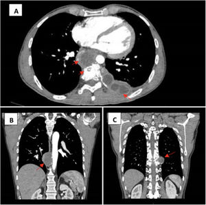 Computerised axial tomography (CAT) with intravenous contrast. (A) Left para-aortic and paravertebral-subpleural collections with erosion of the vertebral body, transverse projection. (B) Para-aortic collection, longitudinal projection. (C) Left paravertebral collection, longitudinal projection.