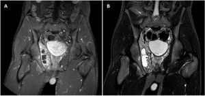 Pelvic MRI. A. With contrast (gadolinium) and T1 enhanced. B. STIR sequence. Collection in right OIM of 6×1.5×5.5cm, with peripheral enhancement (A) and signal hyperintensity (B). Signal alteration in the ischial tuberosity that enhances with contrast (A).