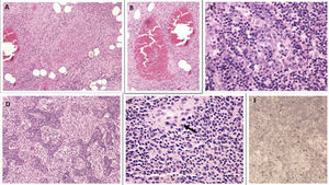 Lymph nodes with necrotising lymphadenitis: ischaemic necrosis with necrotising vasculitis (A), periganglionic vessels with red thrombus (B), follicular hyperplasia with immunoblastic reaction (C), plasmacytosis and sinus histiocytosis (D). Presence of occasional microgranulomas (E) (arrow). Positive immunohistochemistry for SARS-CoV-2 (F).