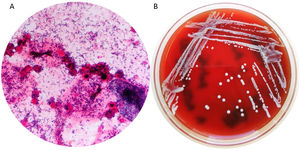 Direct Gram stain from the amniotic fluid revealed unbranched gram-positive bacilli (A). White colonies of Actinomyces neuii isolated on blood agar after 48h of incubation (B).
