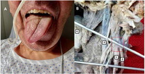 A) Right hemitongue deviation due to ipsilateral 12th cranial nerve paralysis. B) 1: vagus nerve; 2: hypoglossal nerve; 3: internal carotid artery; 4: soft palate. Box: point of anatomical proximity between the vagus and hypoglossal nerve.