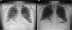 Chest radiography, showing: (A) bilateral interstitial involvement, with a pneumothorax chamber (black arrow). (B) Disappearance of the previously visible pneumothorax chamber.