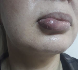 A papule on the buccal surface of the lower lip and a swollen submandibular lymph node.