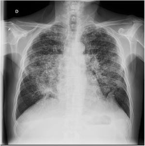 Chest radiography revealed numerous micronodules uniform in size and widespread in distribution.