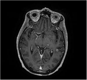 Magnetic resonance imaging showed leptomeningeal enhancement and parenchymal disease consisting on the presence of multiple well-defined nodular low signal lesions which, following the injection of gadolinium, enhanced peripherally, as the one showed on this T1 axial image with contrast.