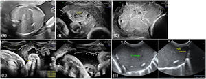 Ultrasound images at 25 weeks of gestation showing liver (A) and placental (B) calcifications. At 28 weeks of gestation, there was progression of calcifications and changes in placental shape (C). At 36 weeks of pregnancy, the patient presented amniochorial detachment (D). Two days after birth, the child had persistent calcifications in the right and left liver lobes (E).