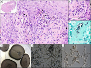 (A) Histological image in which brown fungal structures can be seen in the ridges of the papillary dermis, both in the cytoplasm of a multinucleated giant cell (arrow) and in a suppurative focus (arrowhead). The presence of a septate fungal structure or muriform body (star) is also noteworthy. In the upper left corner, panoramic view showing pseudoepitheliomatous hyperplasia (H&E, ×400). (B) Detail of the muriform cell in image A with digital magnification (H&E, ×400). (C) Fungal microorganisms highlighted with Grocott's methenamine silver stain also showing thick-walled septate bodies, digitally augmented (H&E, ×400). (D) Macroscopic fungal growth, day 25 to 30°C on Sabouraud dextrose agar. (E) Microscopic observation of a fresh preparation of potato-chloramphenicol agar (×400). (F) Detail of conidiophores, from malt extract agar (×1,000).