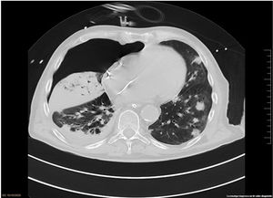 Chest CT showing bilateral consolidative and nodular consolidations. Pneumothorax in right lung (iatrogenic after intubation).