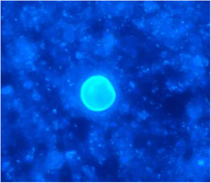 Gram and Calcofluor stain showing spherules and endospores inside them.