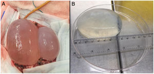 (A) Dissection of hydatid cysts using the Dowling technique (note the catheter in the upper part of the image, in the deep plane between the medial cyst and the brain). (B) Macroscopic appearance of the largest cerebral hydatid cyst. Measurements: 8.5 cm in length and 110 ml in volume.