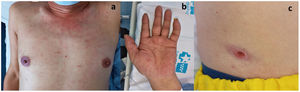 On physical examination the patient presented (a) maculopapular rash affecting trunk (b) palmar involvement (c) a crust over a well-delimited ulcer compatible with a black eschar.