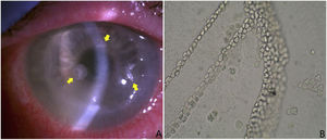 (A) Three thinned lesions with sublesional endothelial halo and with a crystalline appearance (yellow arrows). Samples were taken from them and were sent to the microbiology laboratory for culture and anatomical pathology for study. These lesions were colonised by S. oralis. (B) Typical growth of Acanthamoeba spp. cysts in Page’s medium covered with Escherichia coli. Presence of laminae contiguous with cysts. Without staining and with magnification ×100.