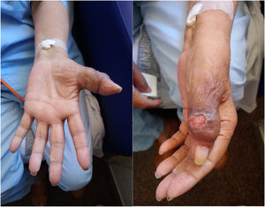 Swelling and skin ulceration on the thumb.